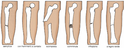 20150417-Docmax-Fratture1